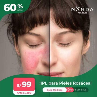 ¡IPL para Pieles Rosácea! 😍- Dalia Medispa (San Borja)