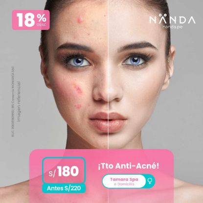 ¡Tto Anti-Acné x Sesión! 😍 - Tamara Spa (a Domicilio)